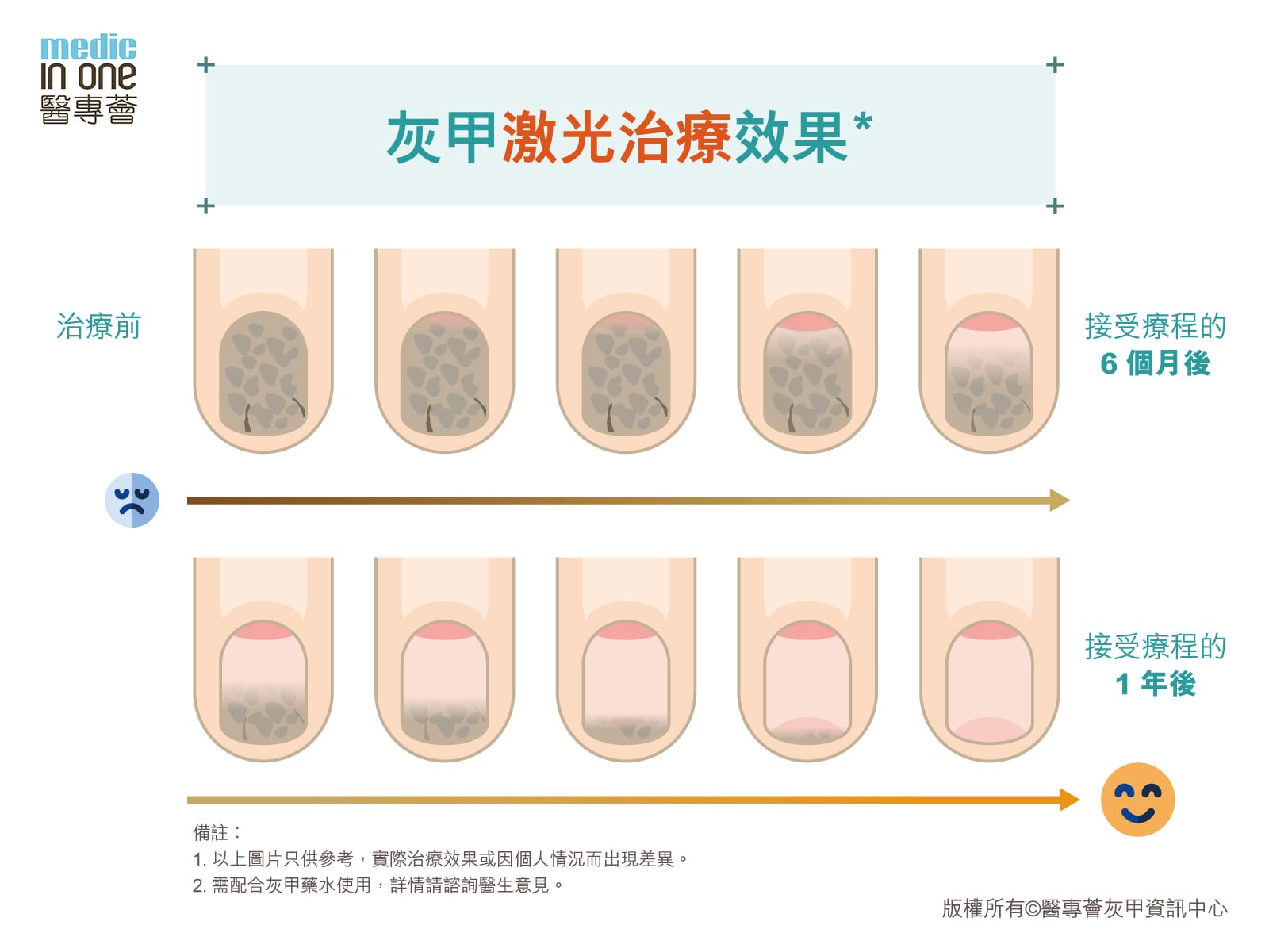 激光治療灰甲 – 醫專薈灰甲資訊中心